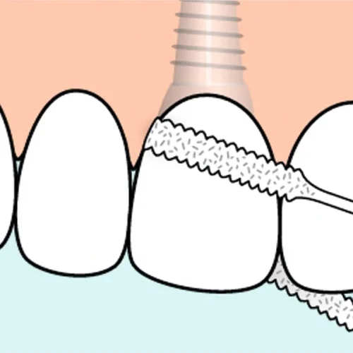 TePe® Bro- og implantattråd