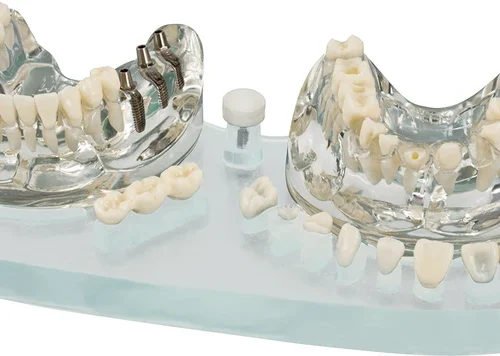 Studiemodell Demo Implant C&B