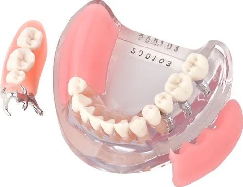 Implantatmodell UK med krone + protese iP9-3100