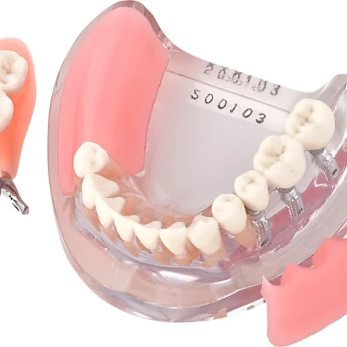 Implantatmodell UK med krone + protese iP9-3100