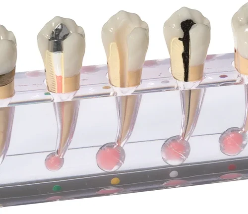 Endodontimodell „Granulom“ P23-END.2