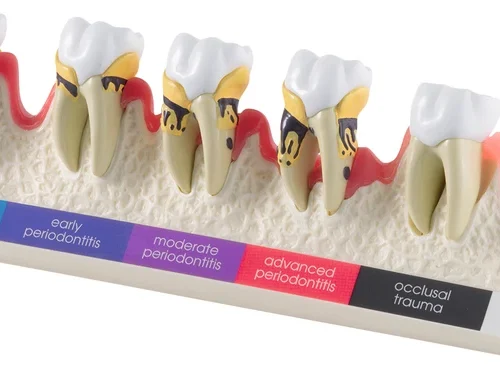 Demonstrasjonsmodell „Parodontose-stadier“ P23-PD1