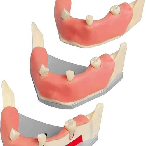 implantat-underkjeve