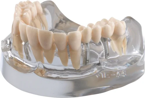 Implantatmodell OK med krone + bro iP12-SB10