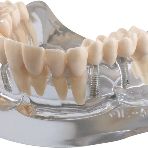 Implantatmodell OK med krone + bro iP12-SB10