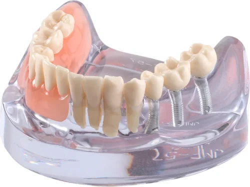 Implantatmodell UK med prothesen iP12-SB11