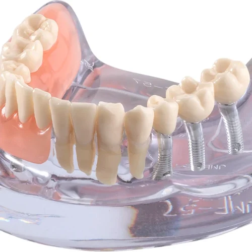 Implantatmodell UK med prothesen iP12-SB11