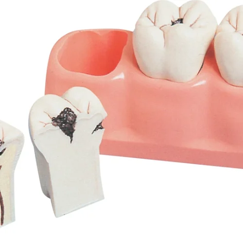 kariesmodell P13-TR7