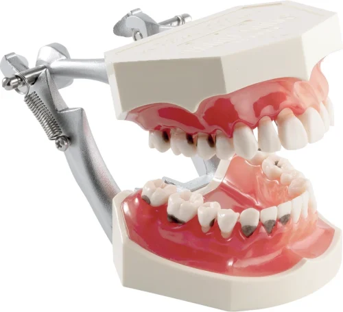 Parodontemodell med karies P2D-001