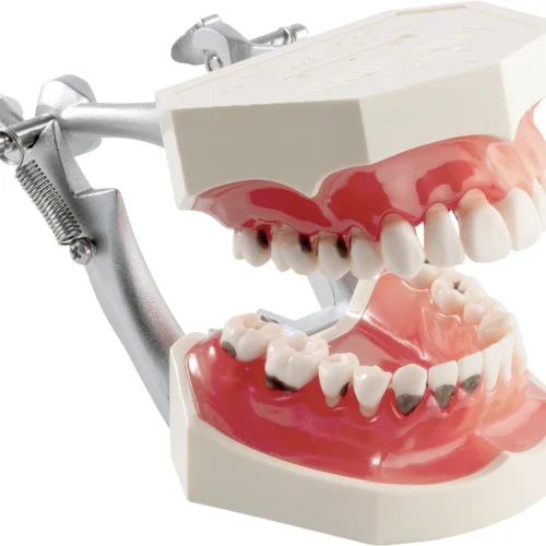 Parodontemodell med karies P2D-001