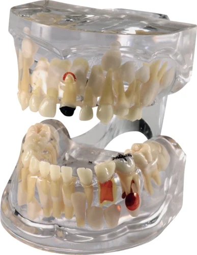 Patologisk vekstmodell med karies P12P-100R