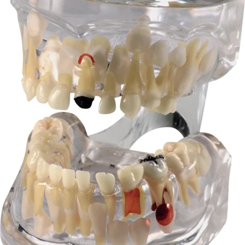 Patologisk vekstmodell med karies P12P-100R