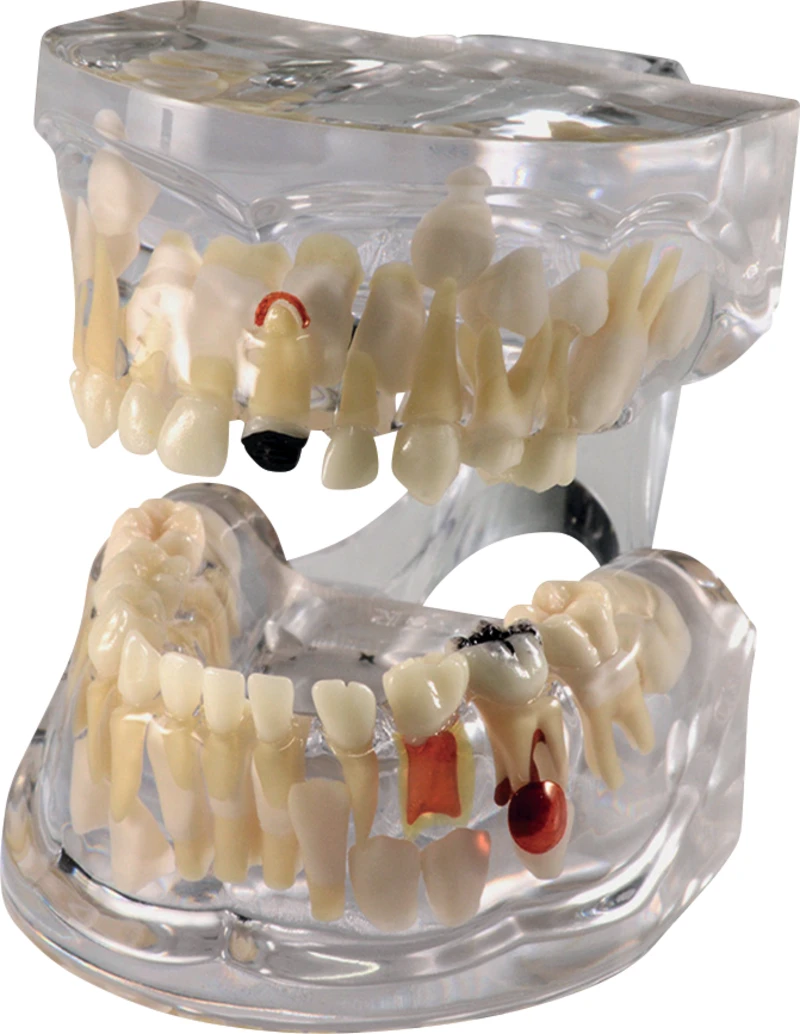 Patologisk vekstmodell med karies P12P-100R